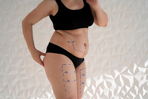 Mujer con exceso de grasa, paciente de lipoescultura y liposucción.