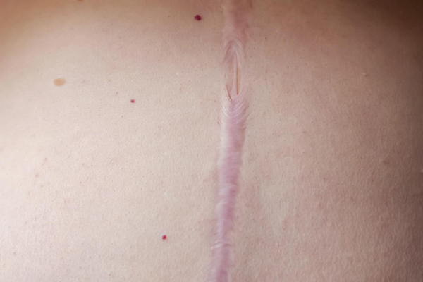 Cicatriz en el abdomen